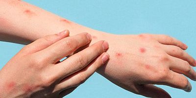 Maymun çiçeği salgını