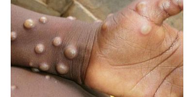 Maymun Çiçeği Virüsü korku yaratıyor!