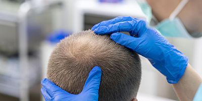 Medikal Estetik Uygulamaları Saç Problemlerini Ortadan Kaldırıyor