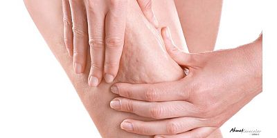 Prof. Dr. Ahmet Karacalar: Selülit sadece selülit değildir, metabolik bir aynadır