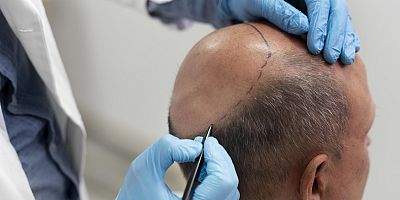 Saç ekimi sağlık için tehdit oluşturur mu?