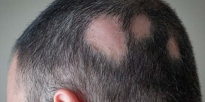 Saçkıran ve Saç Dökülmesi Sebepleri