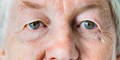 Sadece yaşlılarda değil gençlerde de görülebiliyor