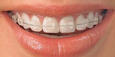 Sahte diş tellerine dikkat!