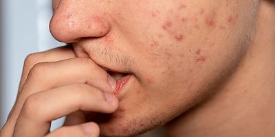 Sınav Stresi Yüzünden Oluşan Akne ve Sivilcelerle Baş Etmenin Yolu Kaygı Yönetiminden Geçiyor