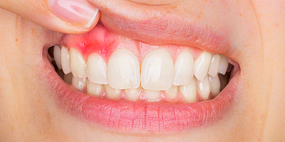 Sinsi hastalık dişlerinizi sessizce yok ediyor