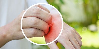 Sivrisinek Isırmasından Sonra Yüksek Ateş Ve Eklemlerde Ağrı Varsa Mutlaka Doktorunuza Danışın