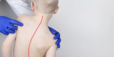 Skolyoz tedavisinde doğru sanılan 7 yanlışa dikkat!
