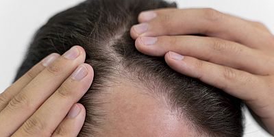 Stres Saç Sağlığını Tehdit Ediyor