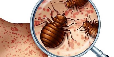 Tahtakurusu ısırması, belirtileri, alerjisi, teşhisi ve tedavisi nasıl yapılır?