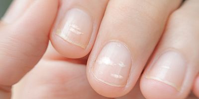 Tırnaktaki değişiklikler birçok hastalığın haberini veriyor!