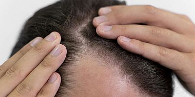 Tiroid Hastalığında Kaybedilen Saçlar Safir Fue Tekniğiyle Geri Kazandırılıyor