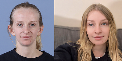 Türk doktor, alın daraltma ameliyatında 11 estetik işlemi daha gerçekleştirdi