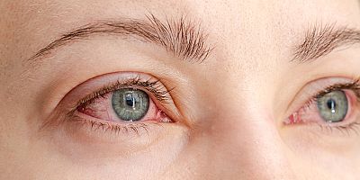 Türkiye’de ve Dünyada 50 Yaş Altı Körlüğün Birinci Nedeni: Diyabetik Retinopati