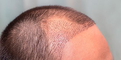 Türkiye, saç ekiminde zafer bayrağını bırakmıyor