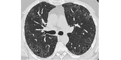 TÜSAD'dan Pulmoner Fibrozis Farkındalık Ayı'nda önemli uyarılar