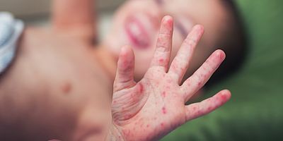 Uzmanından ‘el, ayak, ağız hastalığı’ uyarısı: “Yazın havuza giren çocuklarda daha sık görülüyor!”