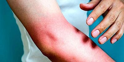 Yanıklarda ilk yardım büyük önem taşıyor!