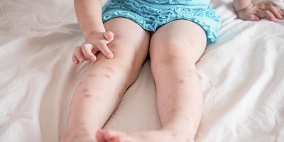 Yaz alerjilerine dikkat!