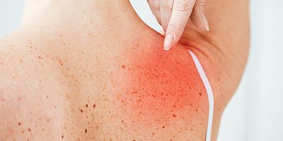 Yaz Sonu Güneş Alerjisine Dikkat