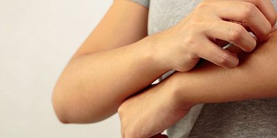 Yazın solar ürtiker tehlikesi