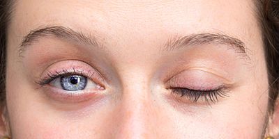 Yüz Felcinde Soğuk Hava Masum mu? 